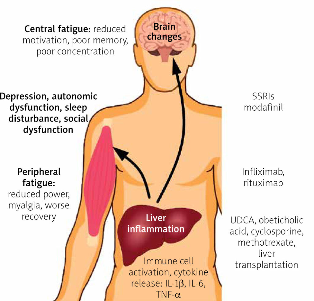 fatty liver disease symptoms
